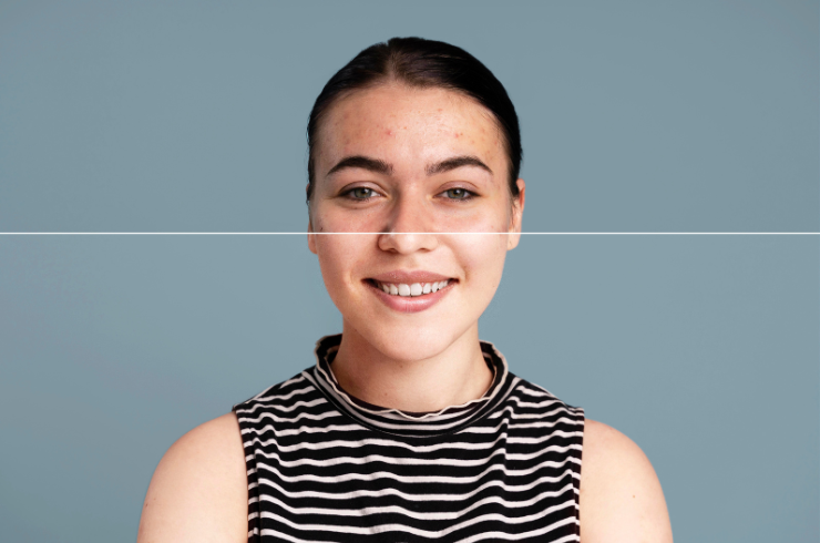 Acne & Scar Treatments